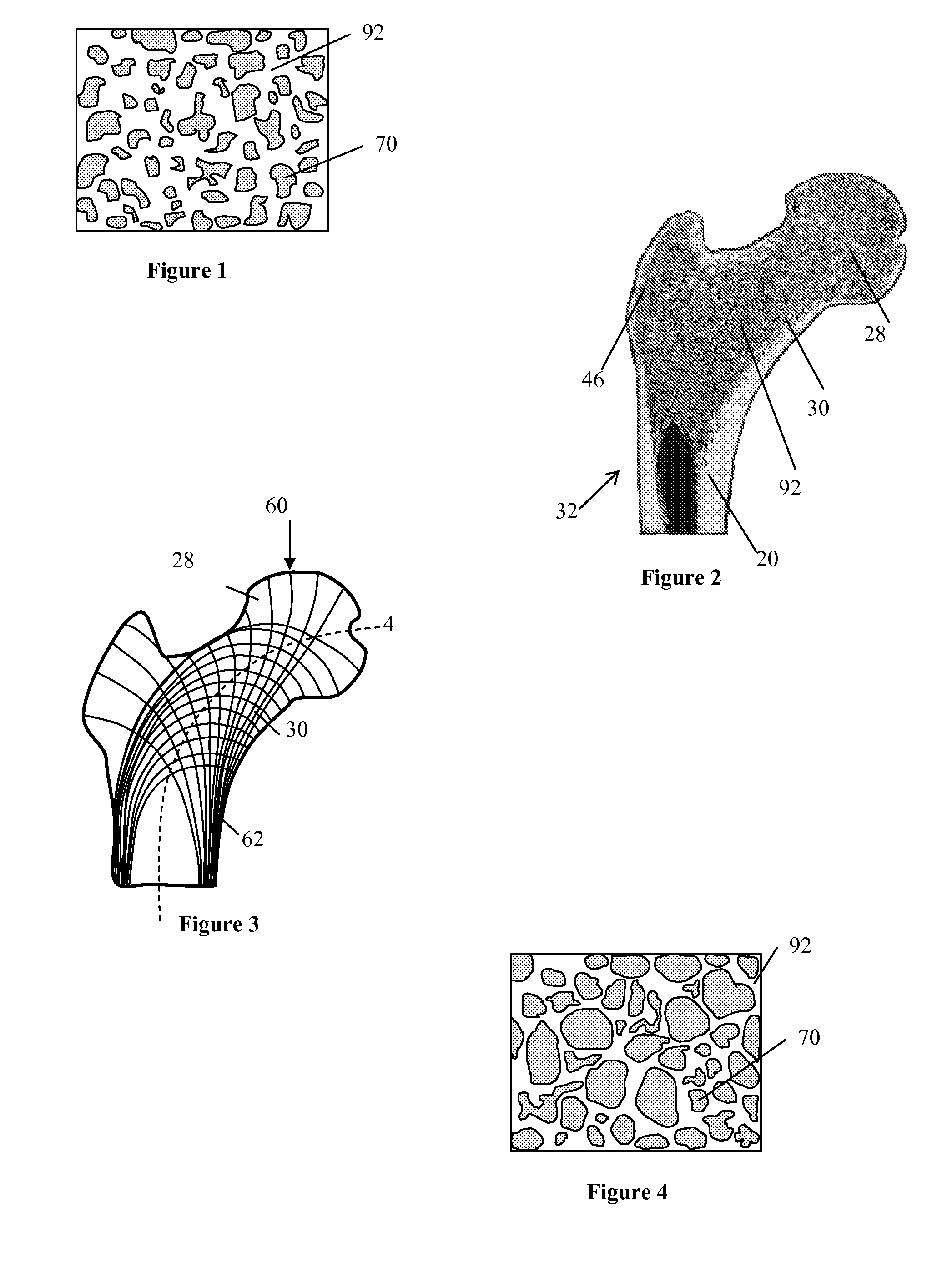 Bone support devices and methods