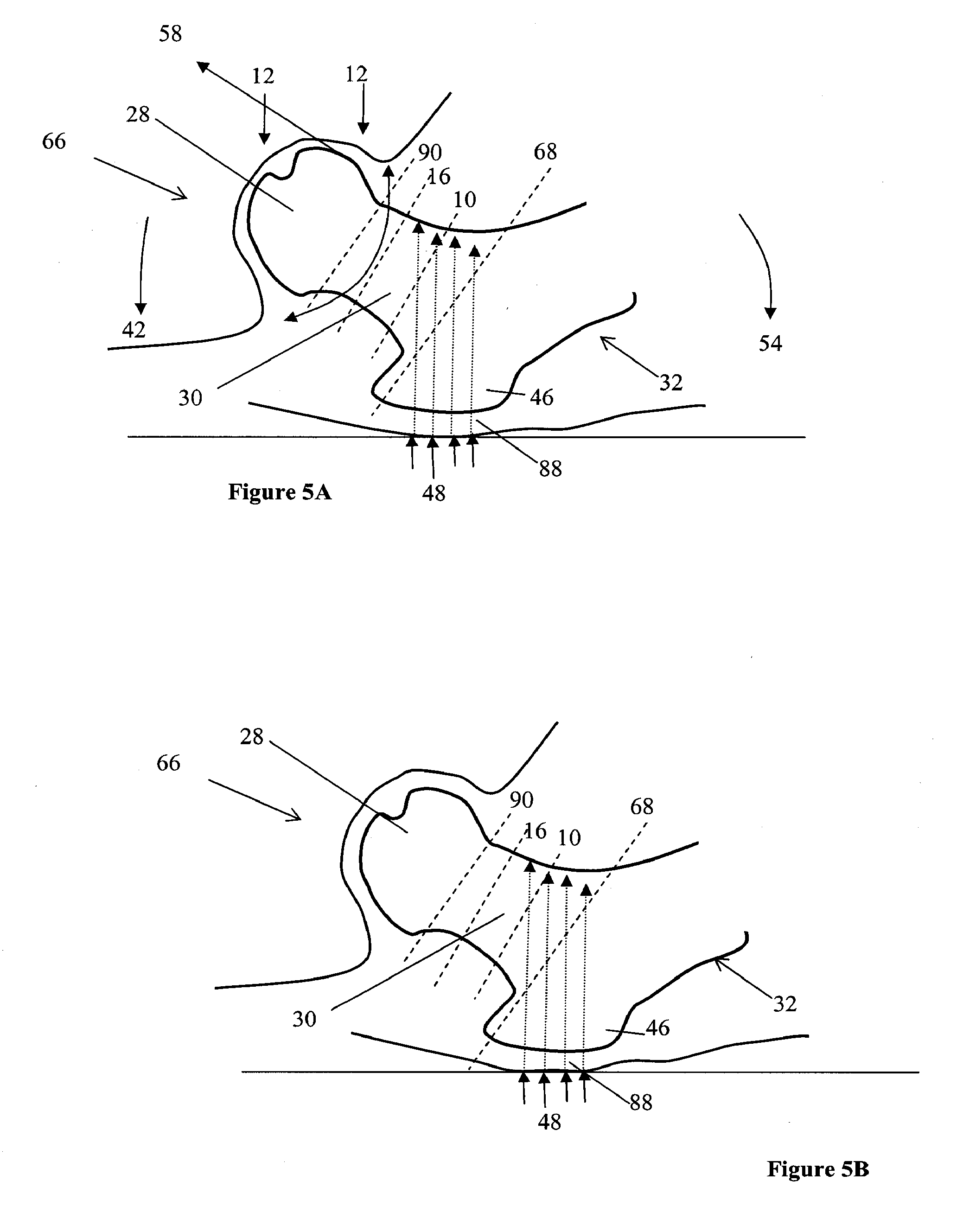 Bone support devices and methods