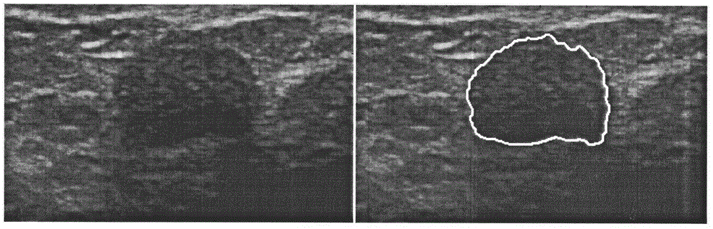 Extraction method of tumor elasticity features based on ultrasound elastography