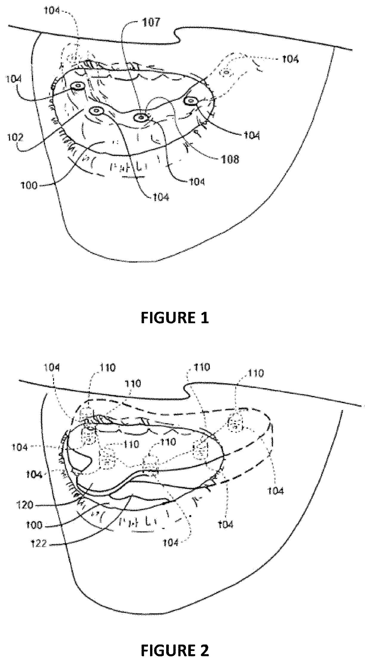 Dental Implant Framework