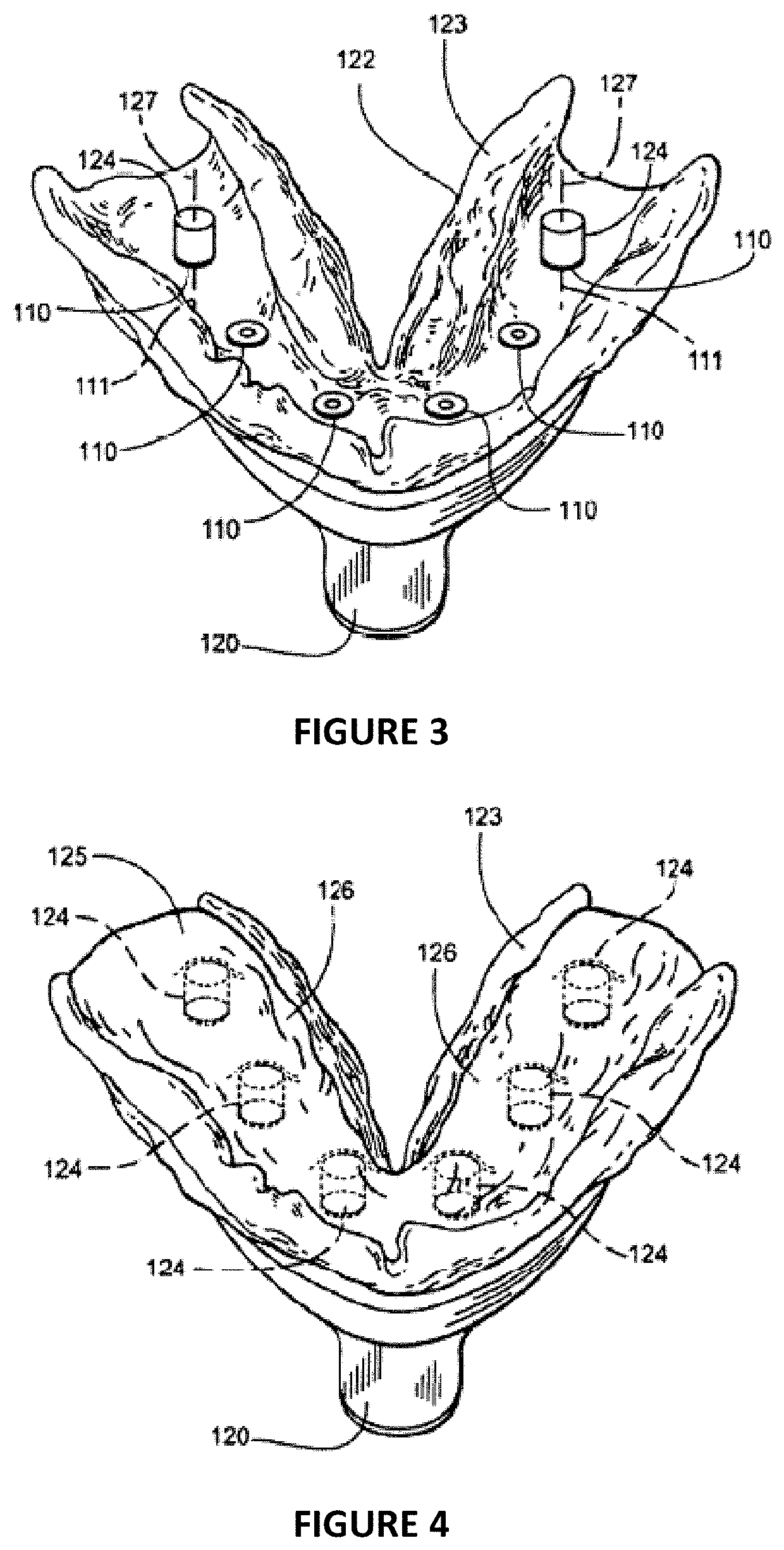 Dental Implant Framework