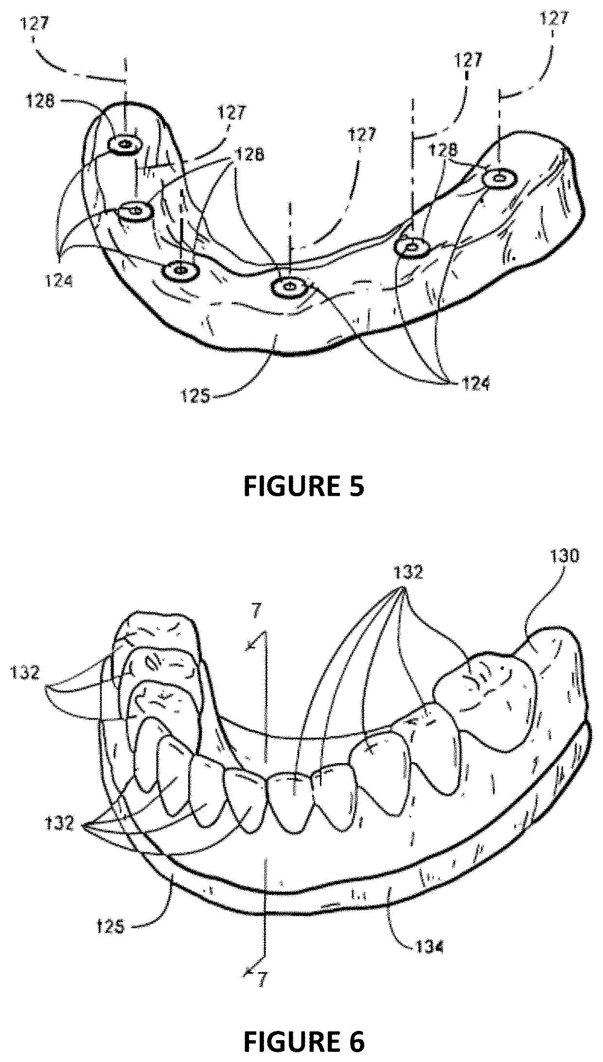 Dental Implant Framework