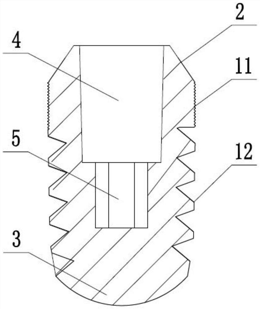 an oral implant