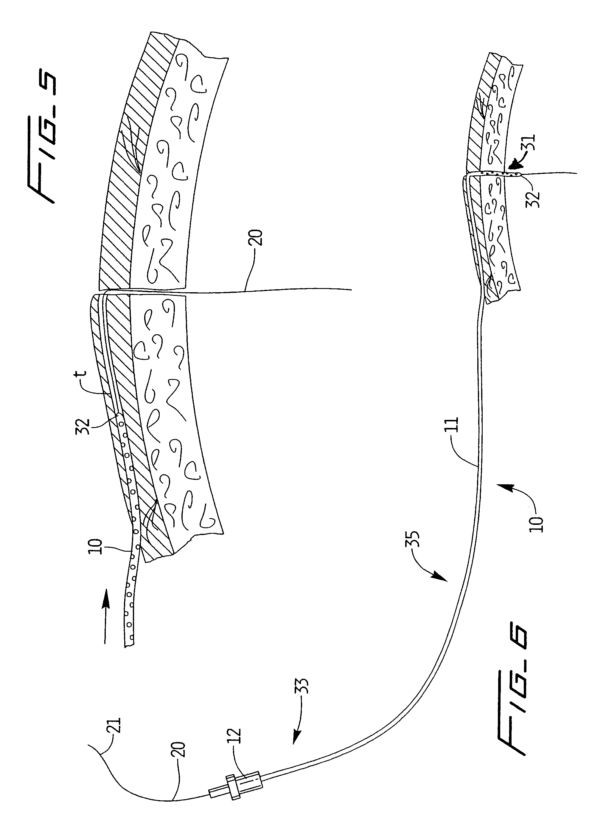 Peritoneal dialysis catheter and insertion method