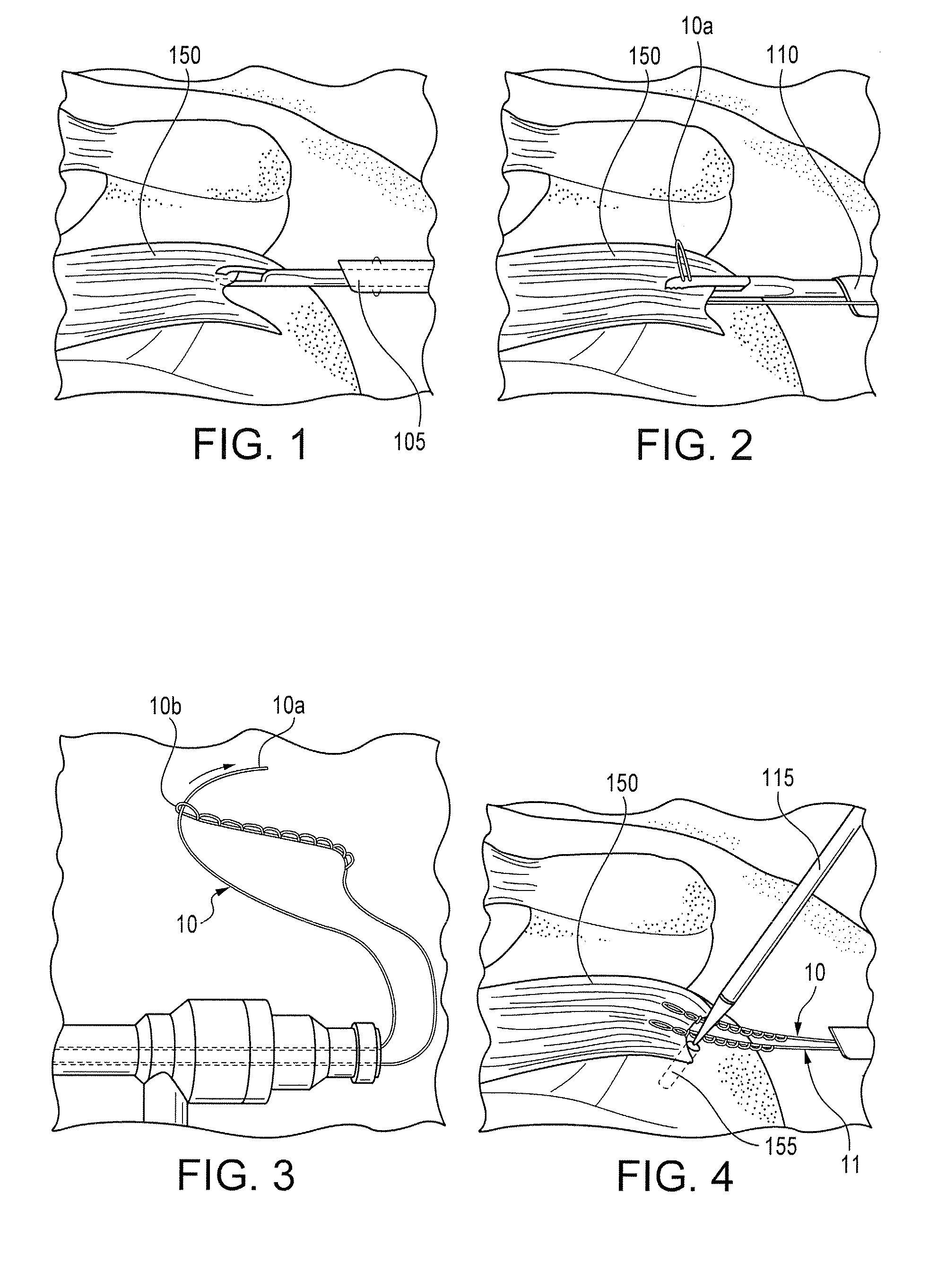 Swivel anchor and method for knotless fixation of tissue