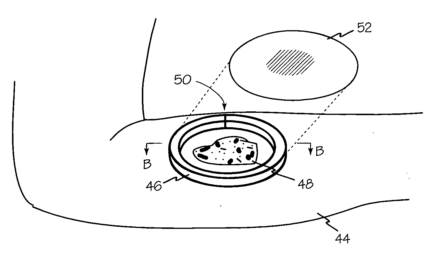 Wound shield and warming apparatus and method
