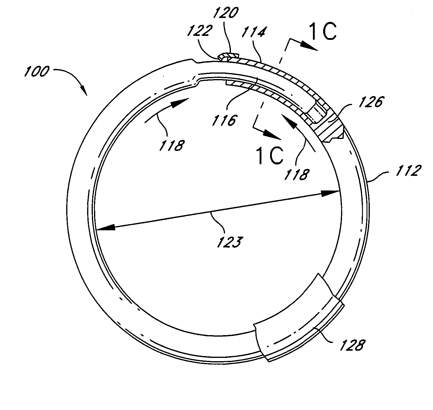 Intraoperative and post-operative adjustment of an annuloplasty ring
