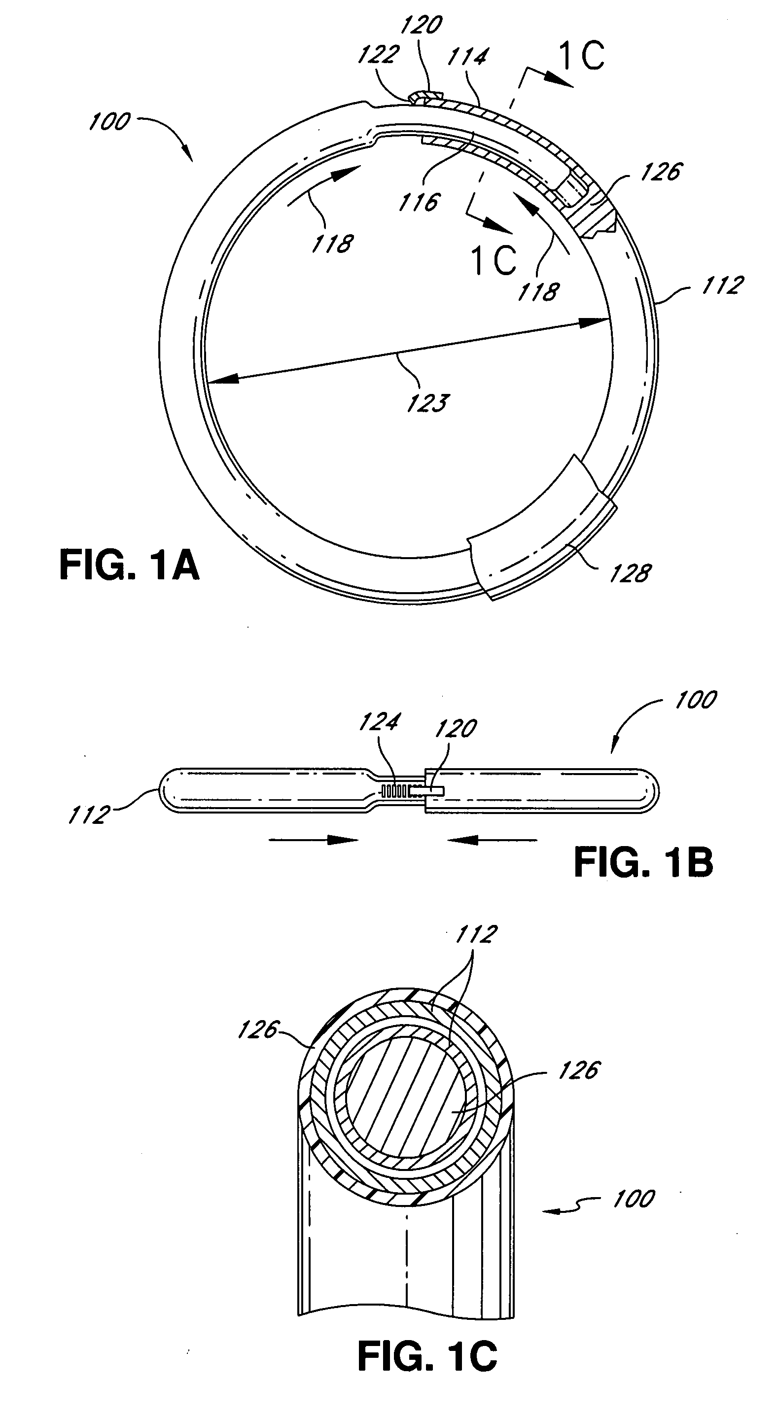 Intraoperative and post-operative adjustment of an annuloplasty ring