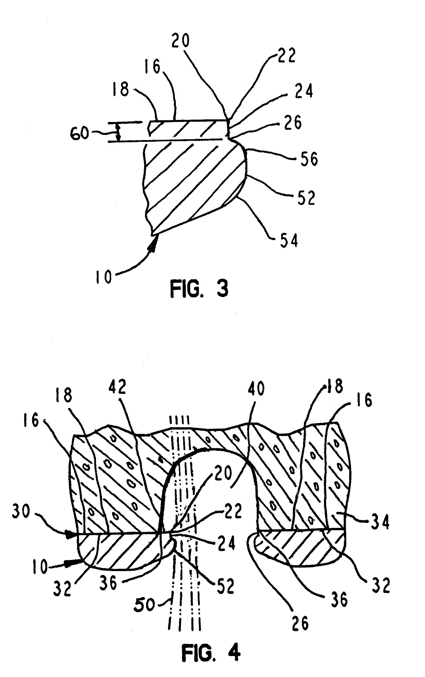 Soft tissue deflection at a prosthetic joint