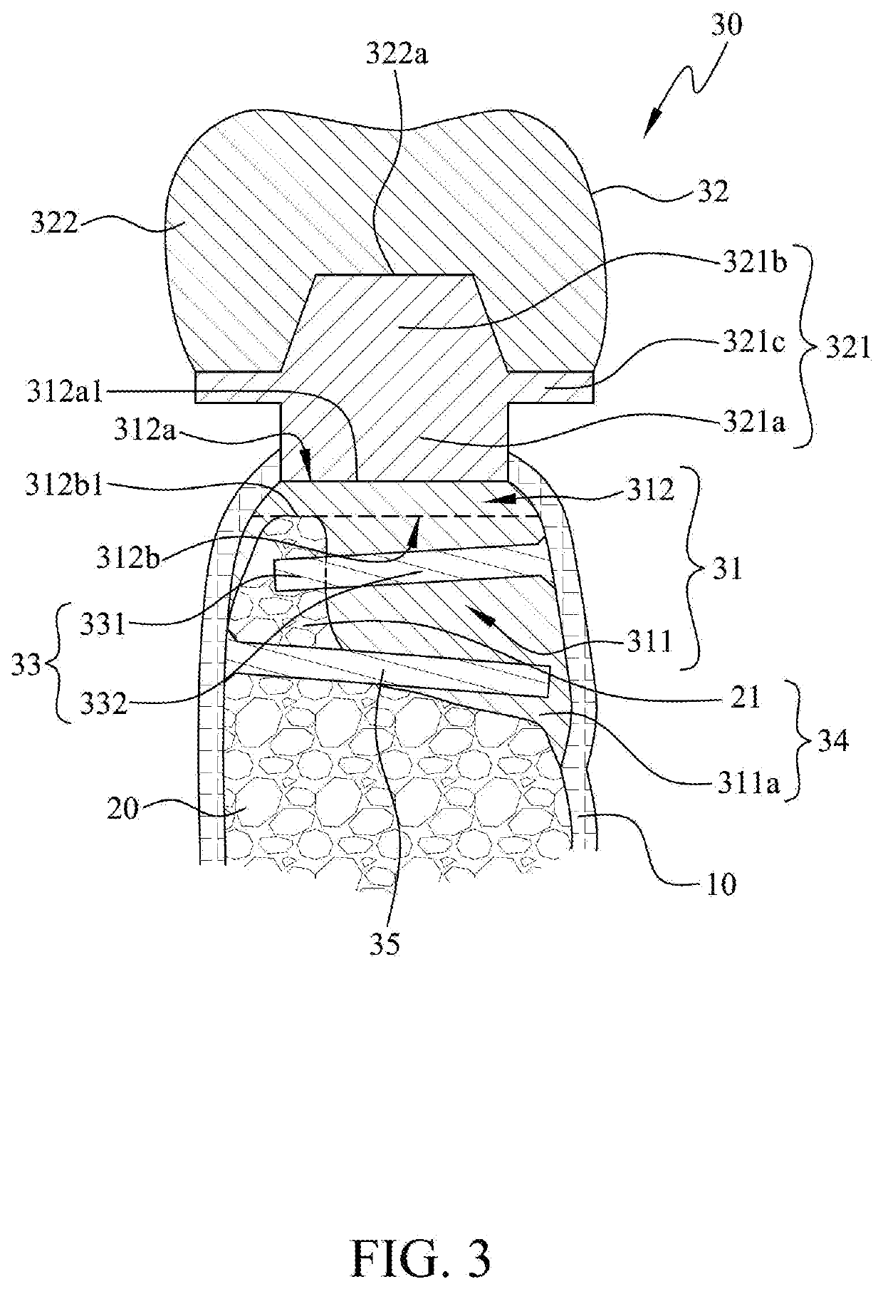 Bone-bonded artificial tooth structure