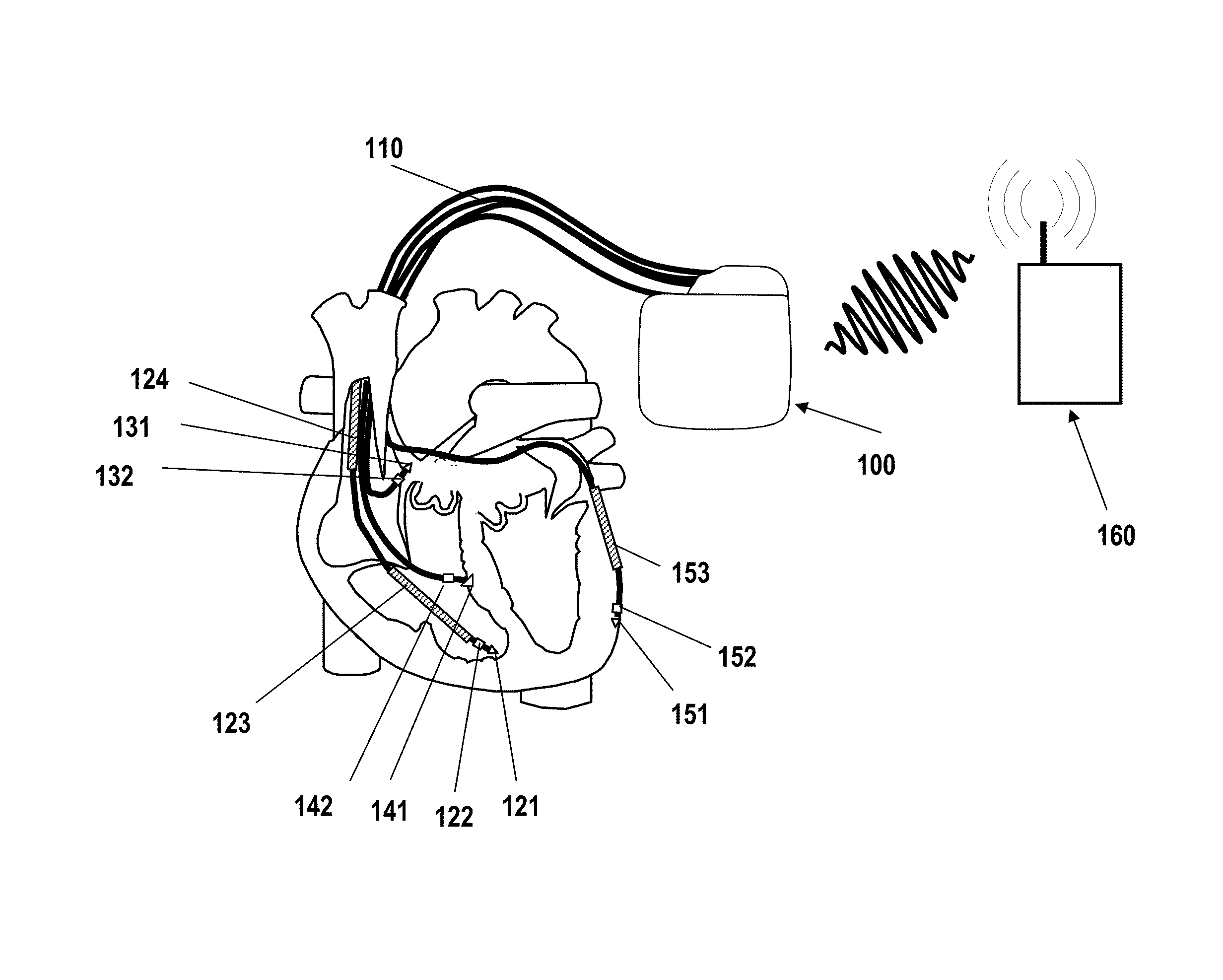 Cardiac stimulator for cardiac contractility modulation