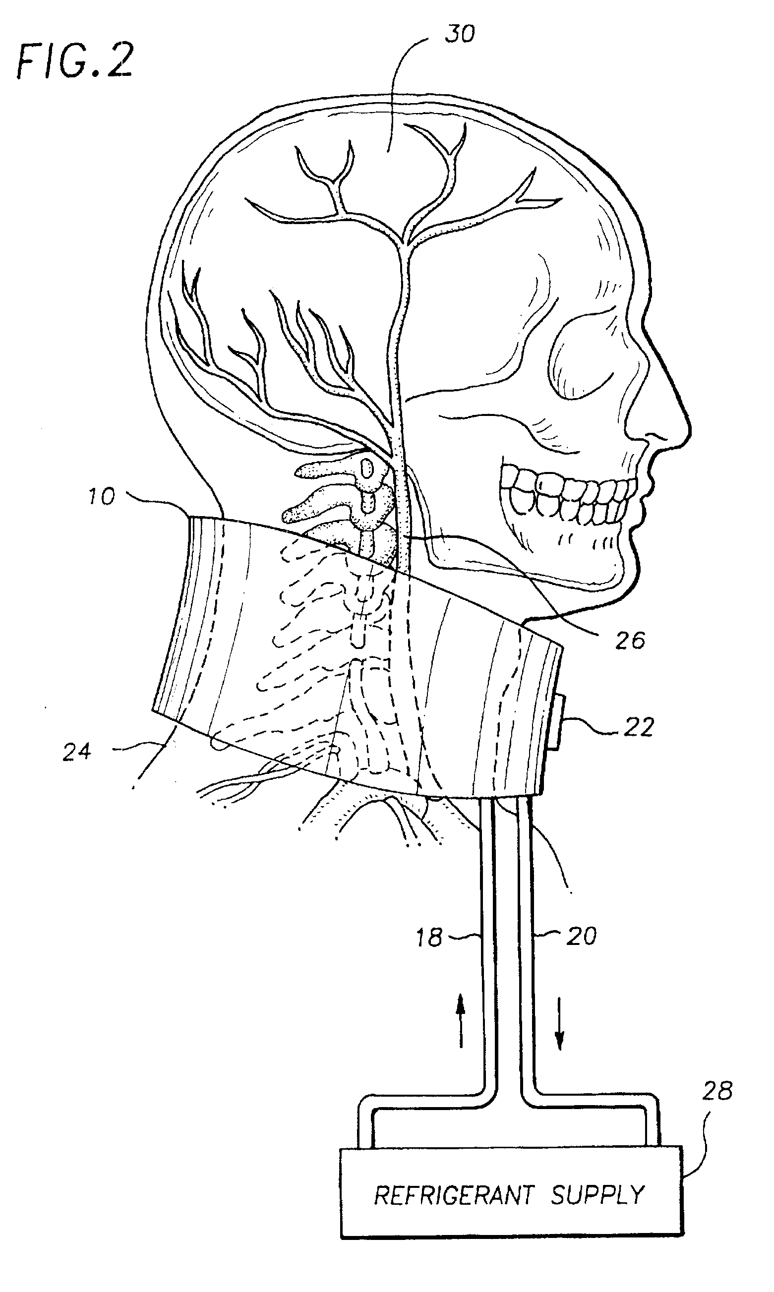 Apparatus for rapid cooling of the brain and method of performing same