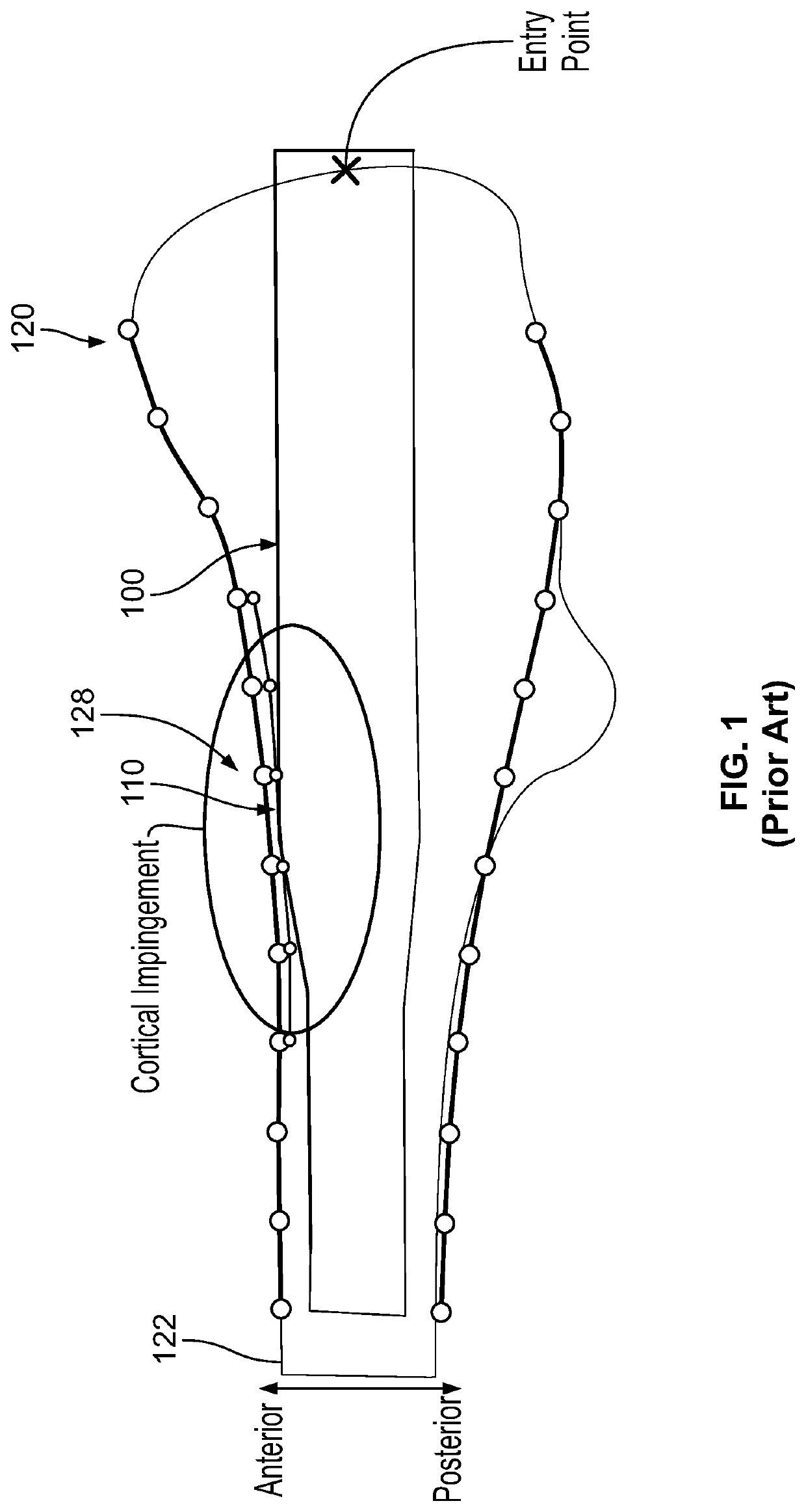 Femoral nail with enhanced bone conforming geometry