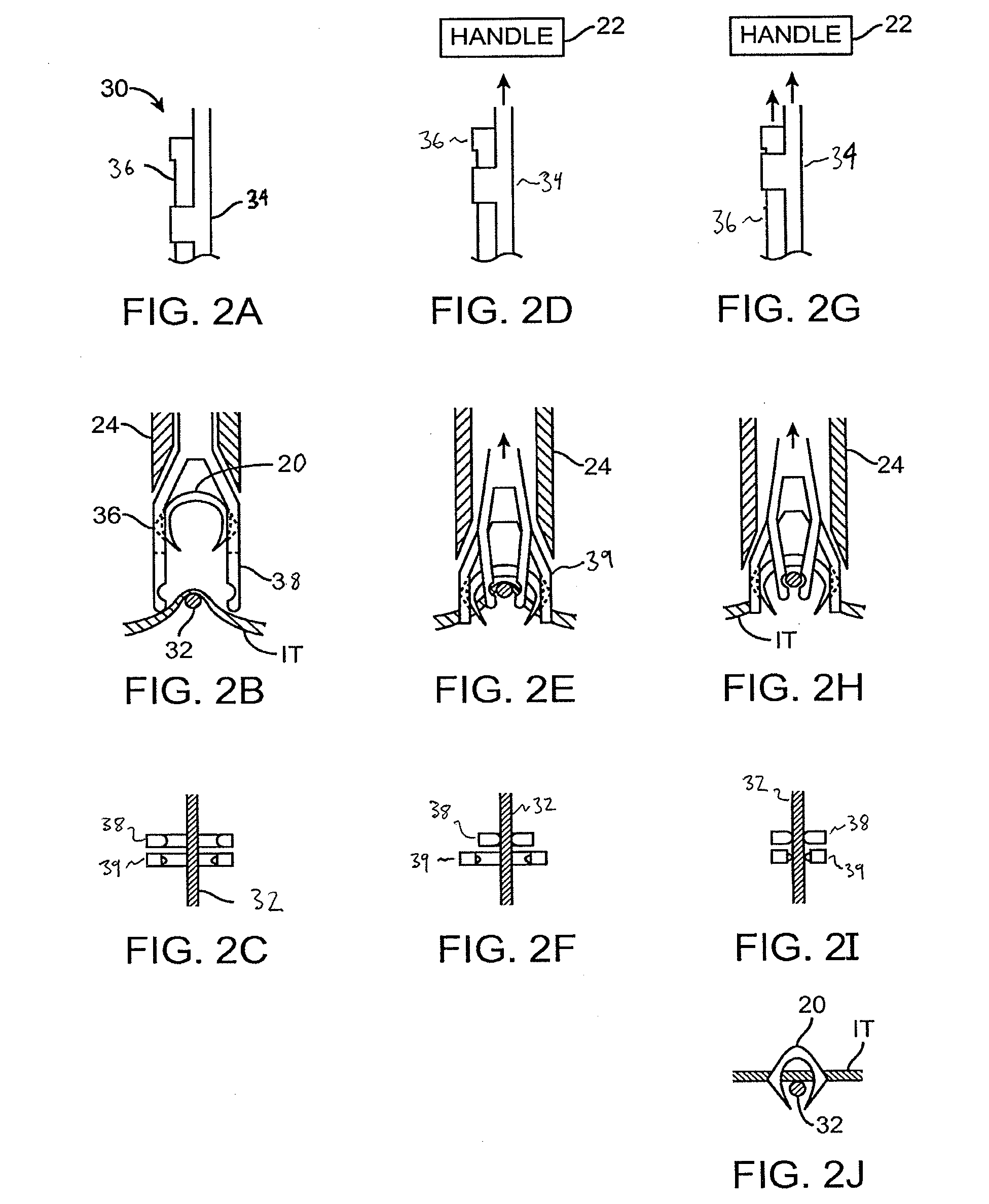 Fasteners, Deployment Systems, and Methods for Ophthalmic Tissue Closure and Fixation of Ophthalmic Prostheses and Other Uses