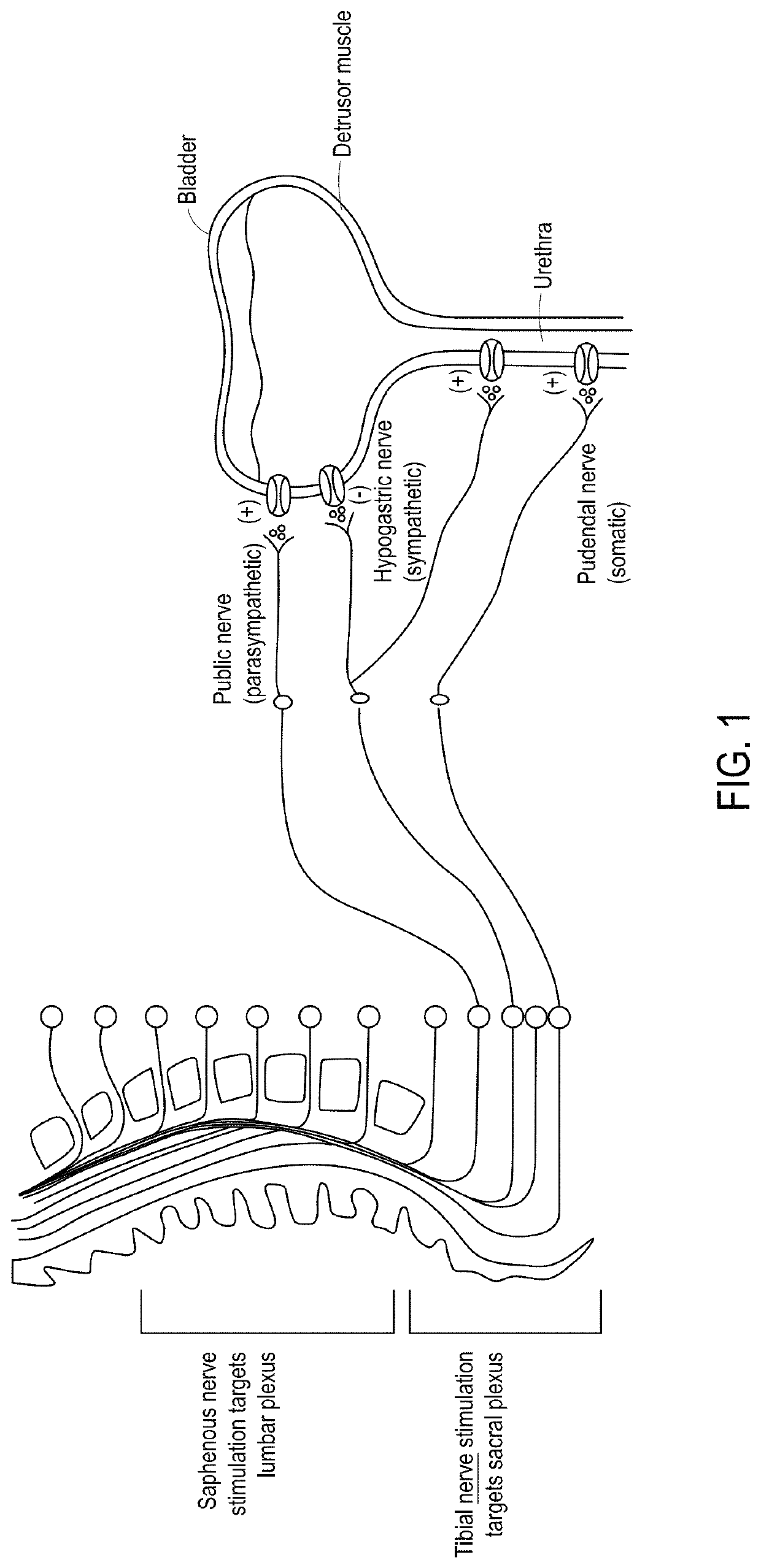 Systems, methods and devices for peripheral neuromodulation for treating diseases related to overactive bladder