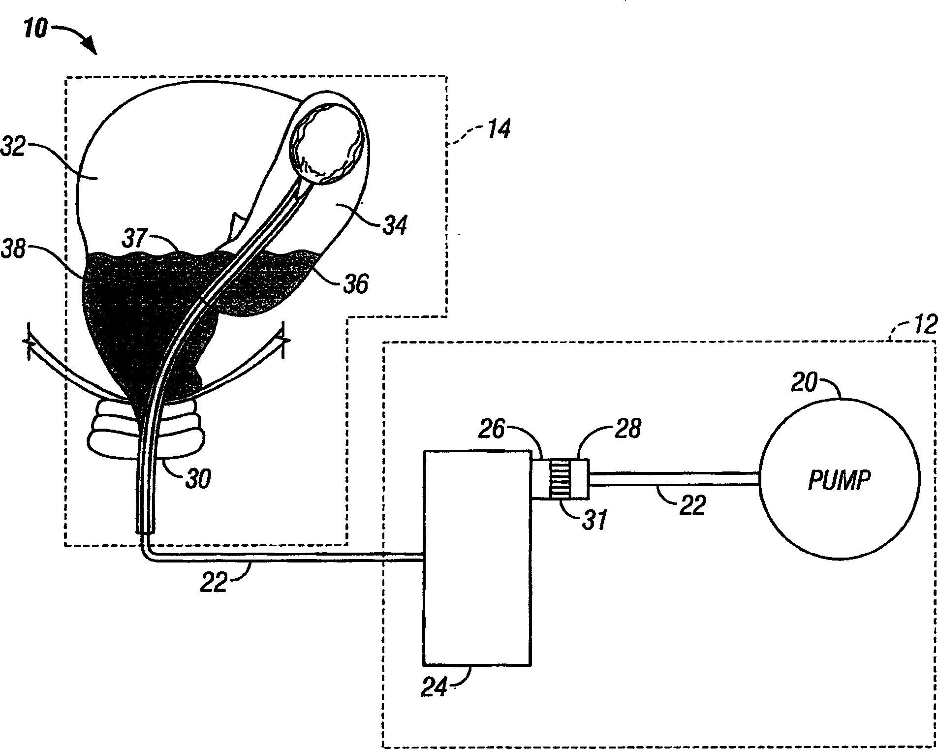 Endoscopic wound care treatment system and method