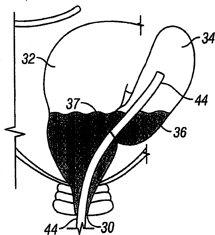 Endoscopic wound care treatment system and method