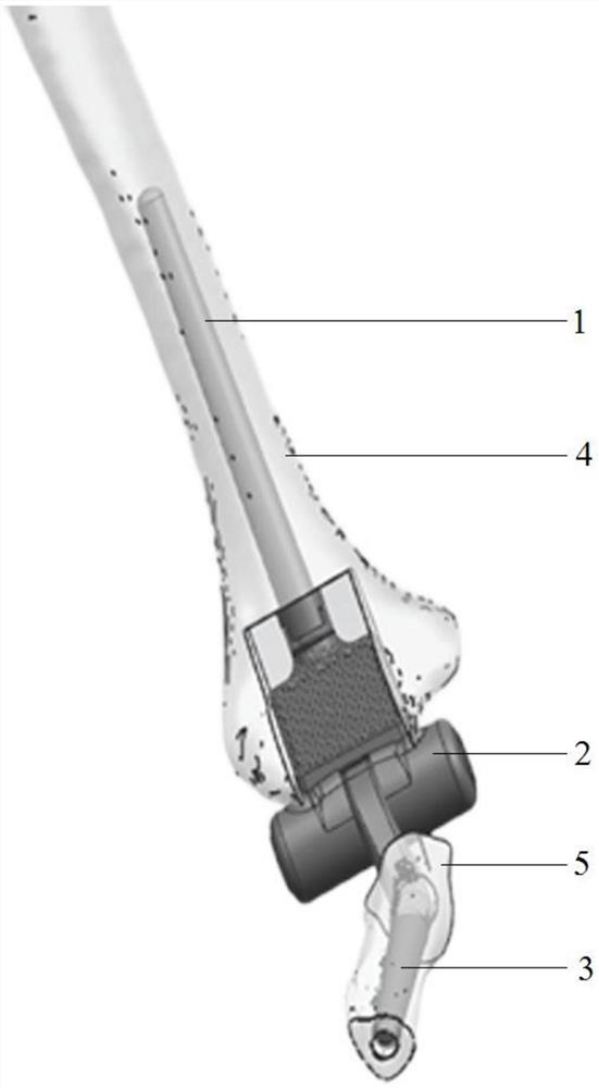 Universal artificial total elbow joint prosthesis