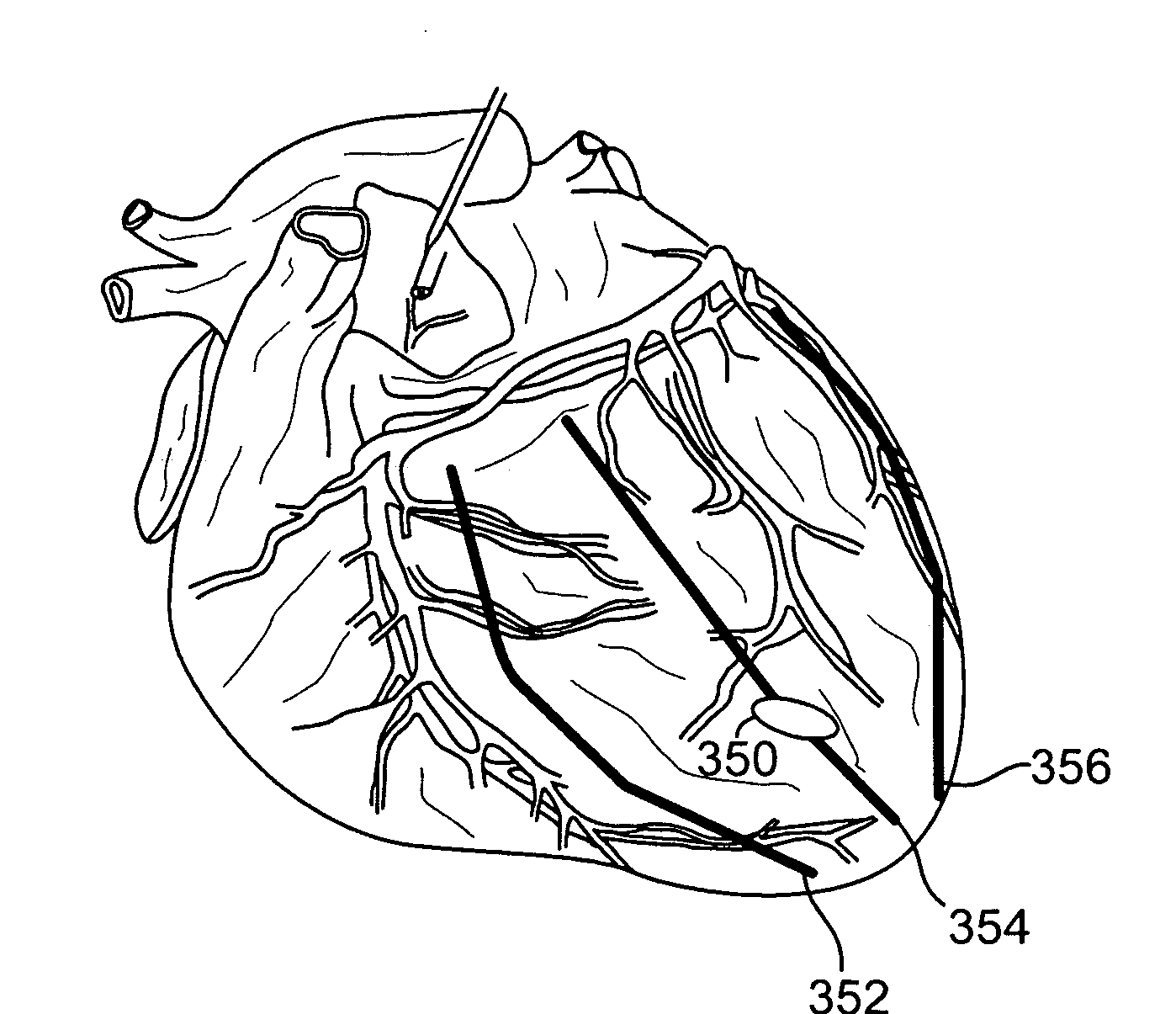 Cardiac patterning for improving diastolic function