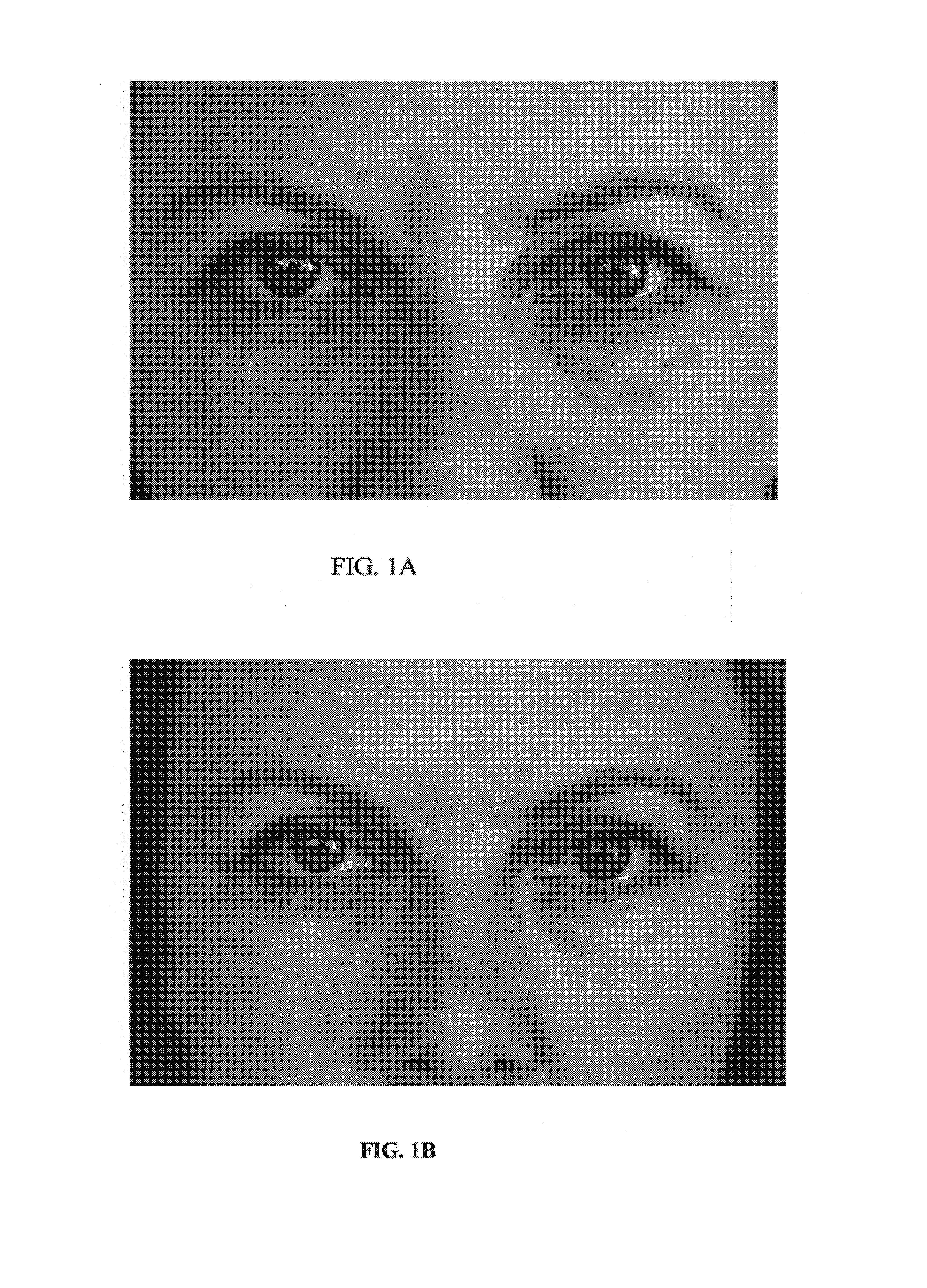Compositions and methods for treatment of skin discoloration