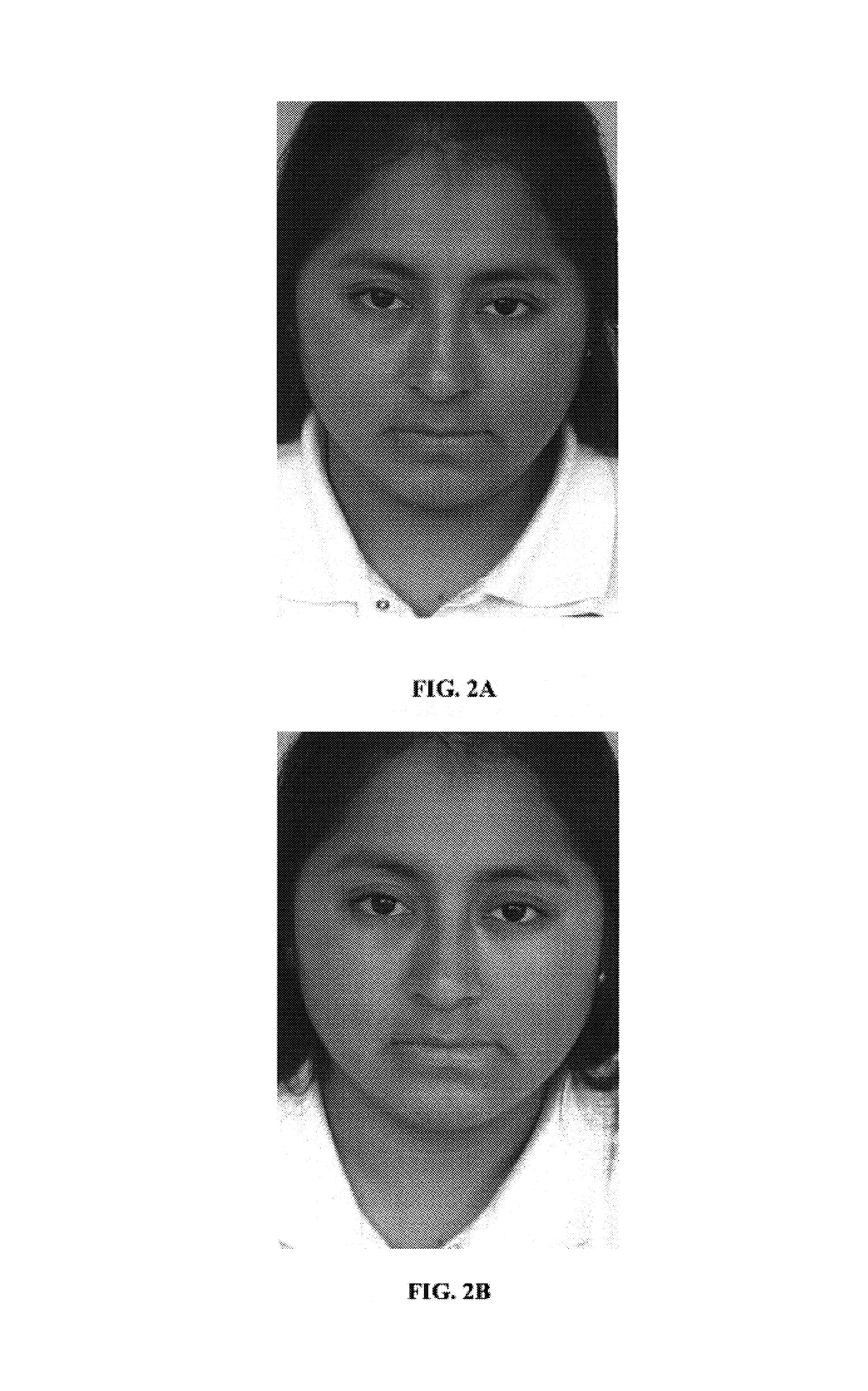 Compositions and methods for treatment of skin discoloration