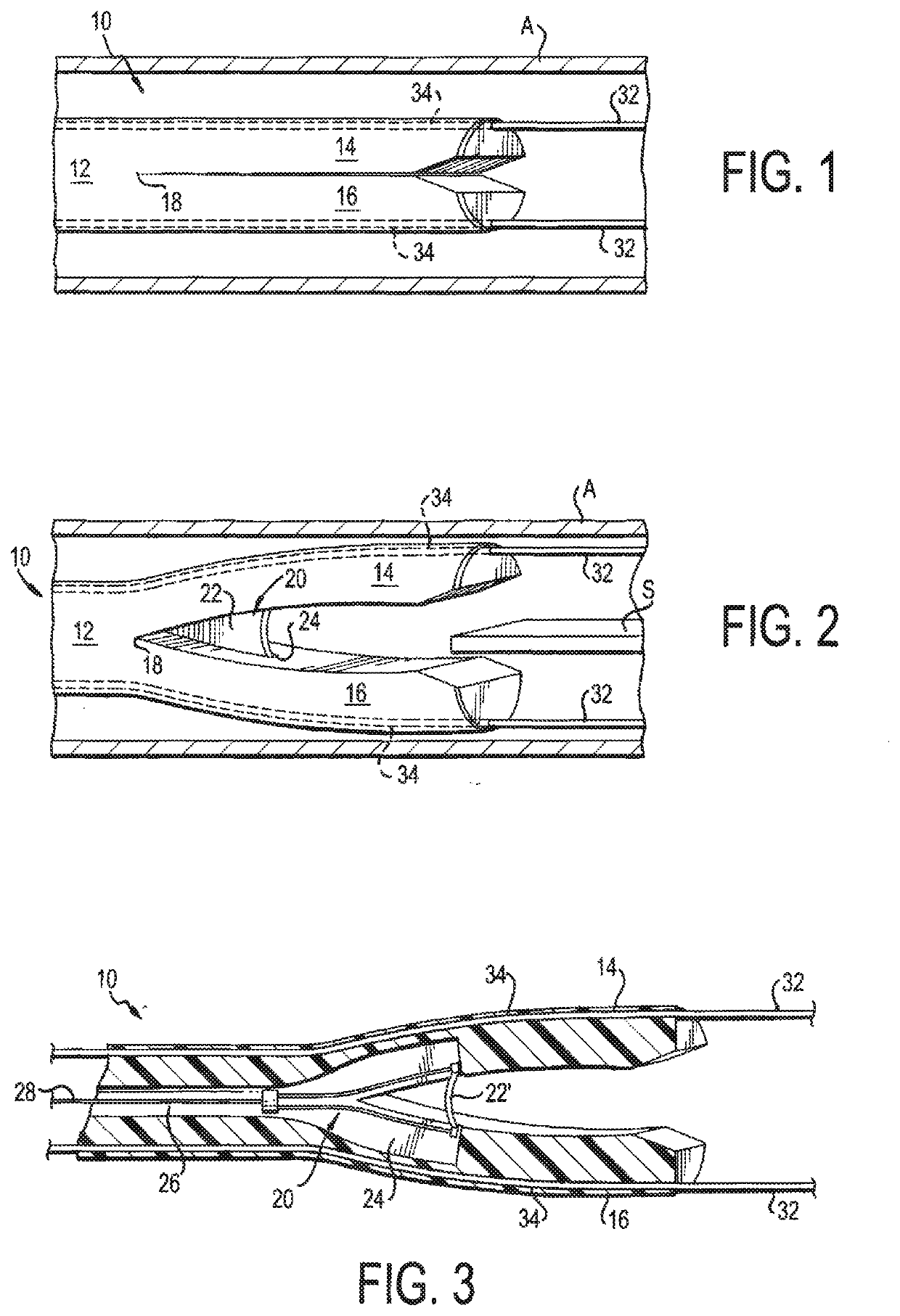 Septotomy Catheter for Aortic Dissection