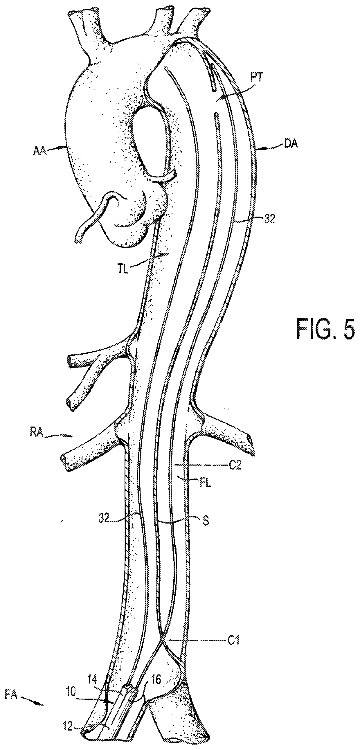 Septotomy Catheter for Aortic Dissection