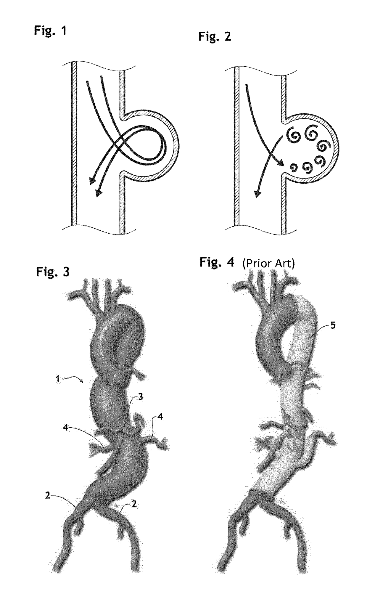 Stent assembly for thoracoabdominal bifurcated aneurysm repair