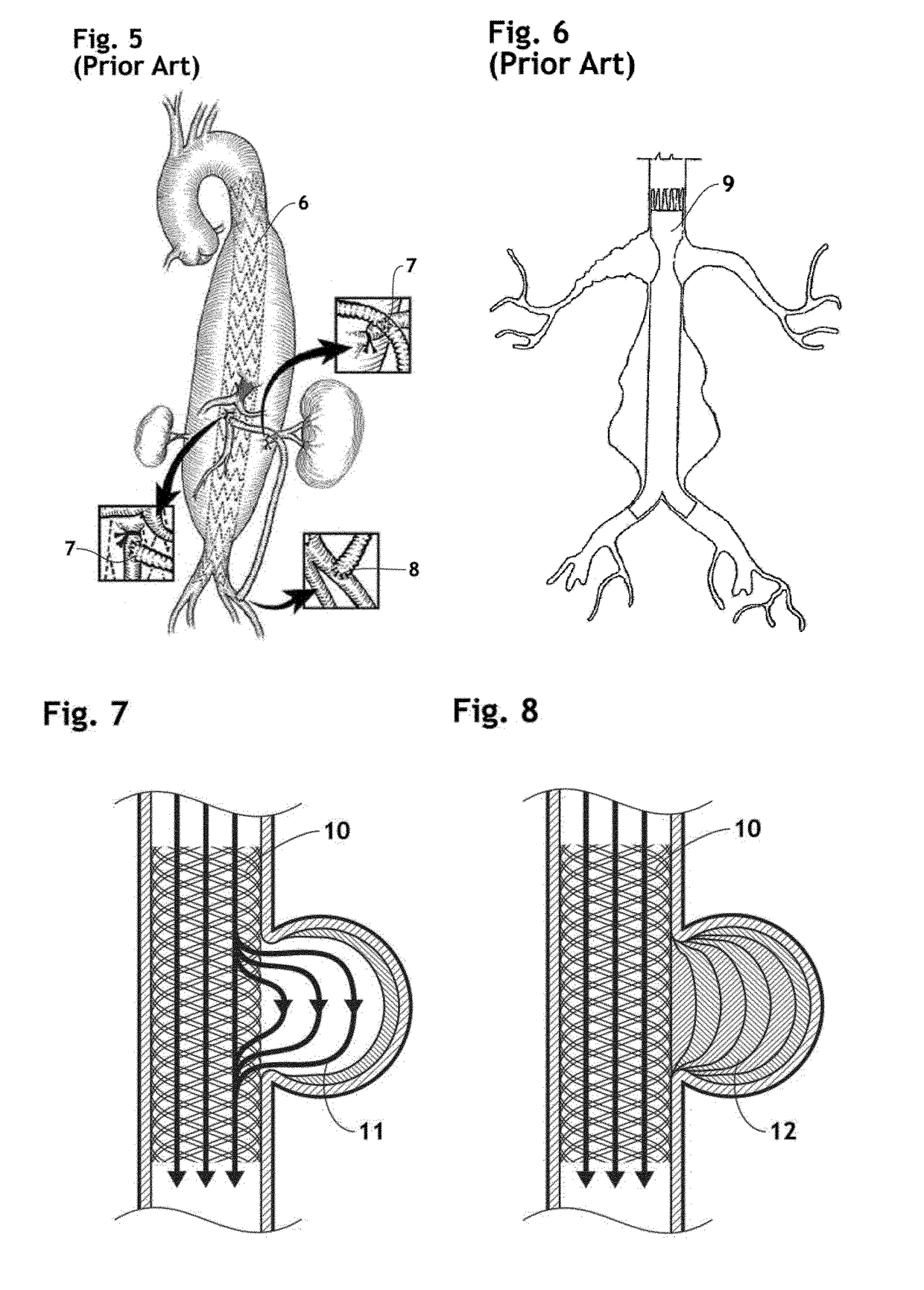 Stent assembly for thoracoabdominal bifurcated aneurysm repair