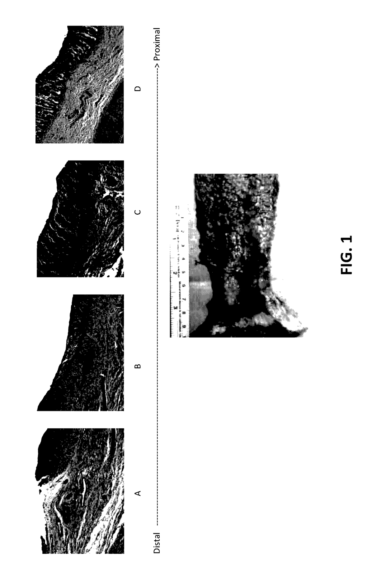 Method and composition for treating inflammatory bowel disease without colectomy