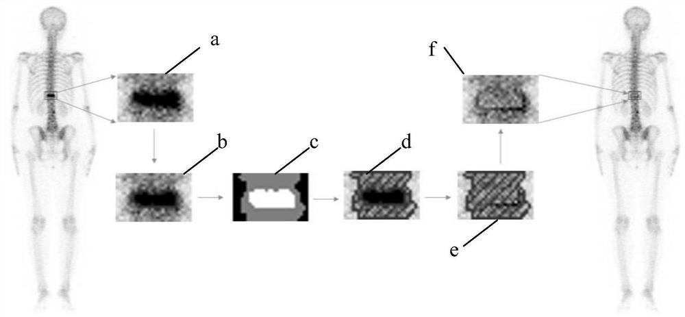 Whole-body bone imaging bone segmentation method based on image set registration