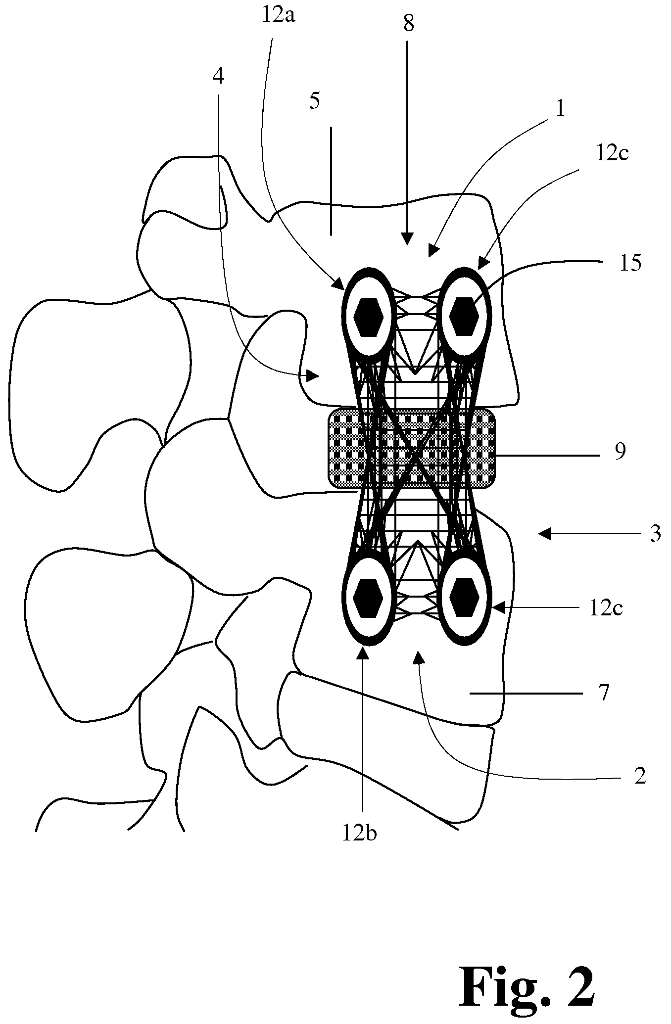 Textile-Based Plate Implant and Related Methods