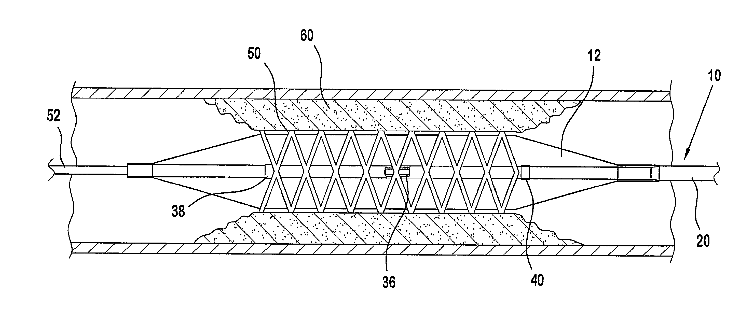 Balloon catheter with centralized vent hole