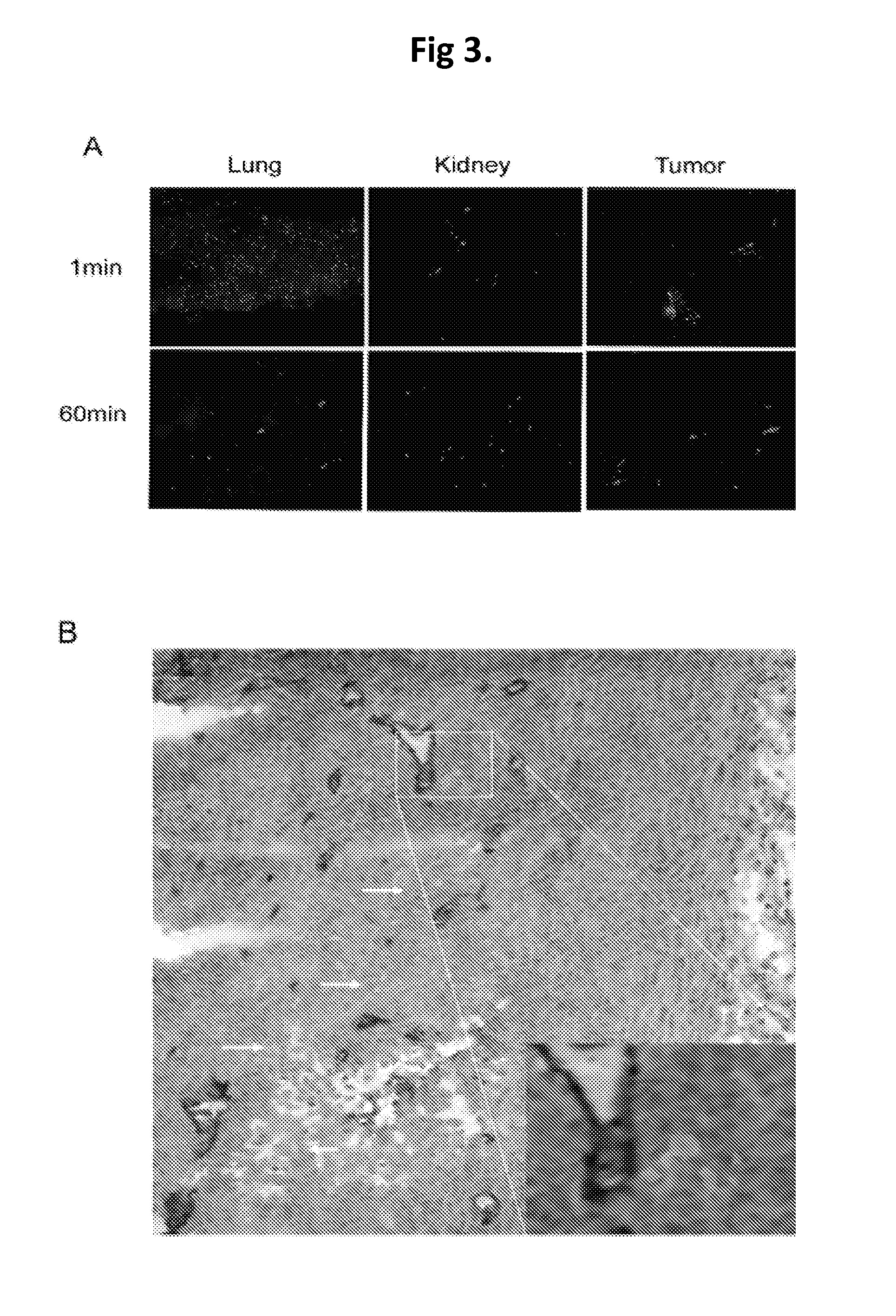 Compositions and methods using siRNA molecules and siRNA cocktails for the treatment of breast cancer