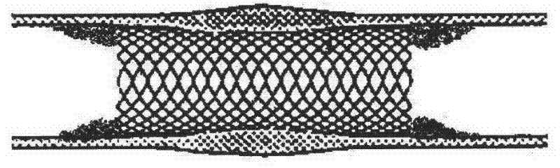 Preparation method for radioactivity TiNi alloy bracket without fringe effect