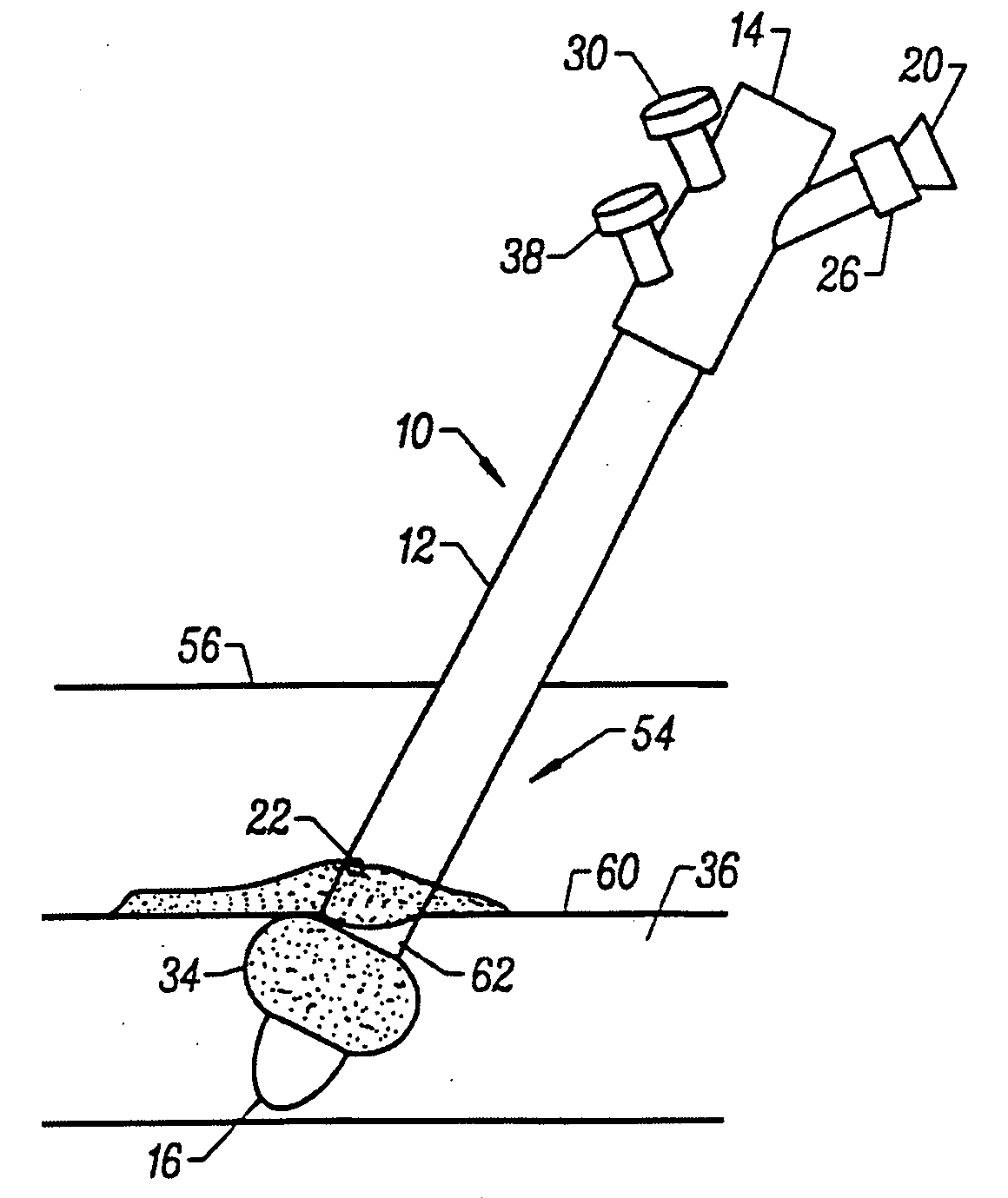 Systems and methods for sealing a vascular puncture