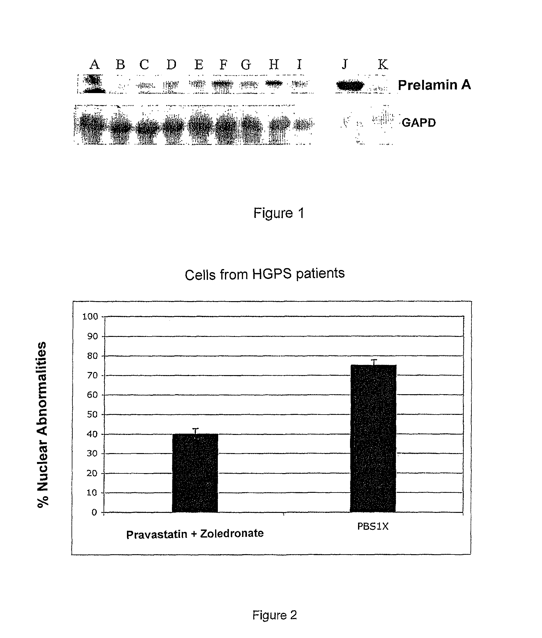 HMG-CoA reductase and farnesyl-pyrophosphate synthase inhibitors for the treatment of conditions related to prenylated proteins in cells