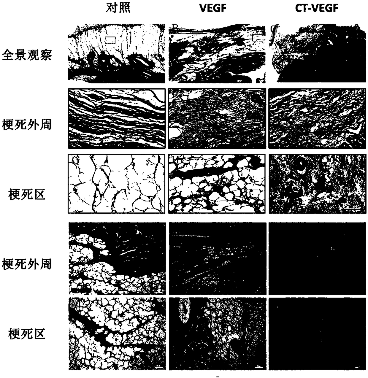 Application of collagen targeted vascular endothelial growth factors in old myocardial infarction treatment
