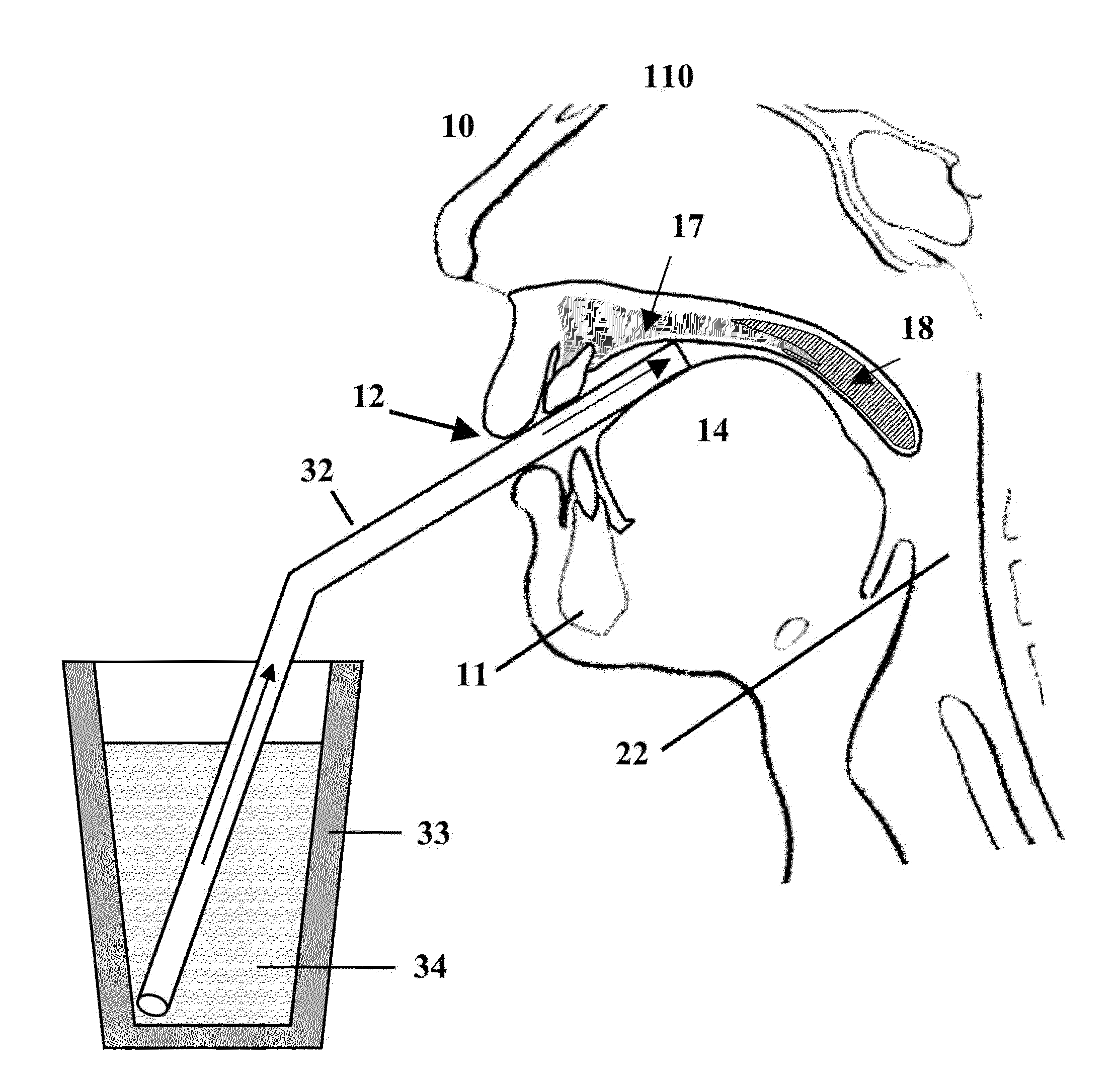 System and method for treatment of snoring