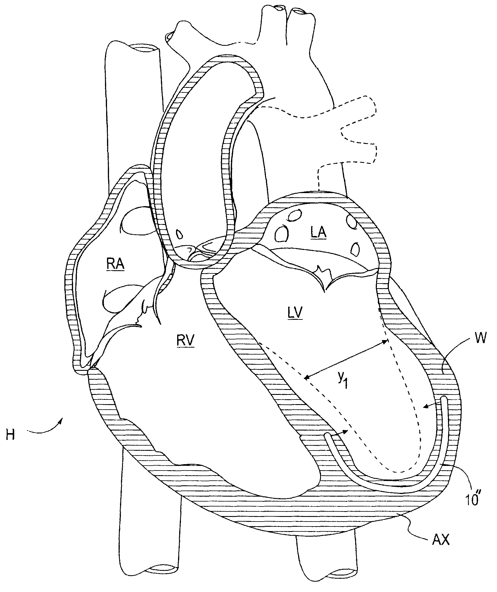 Methods and systems for cardiac remodeling via resynchronization