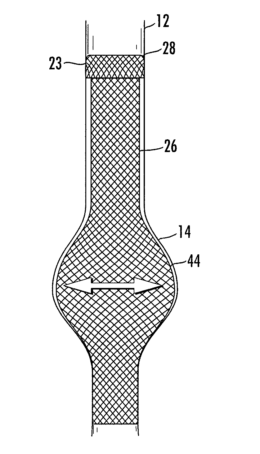 Stent/stent graft for reinforcement of vascular abnormalities and associated method