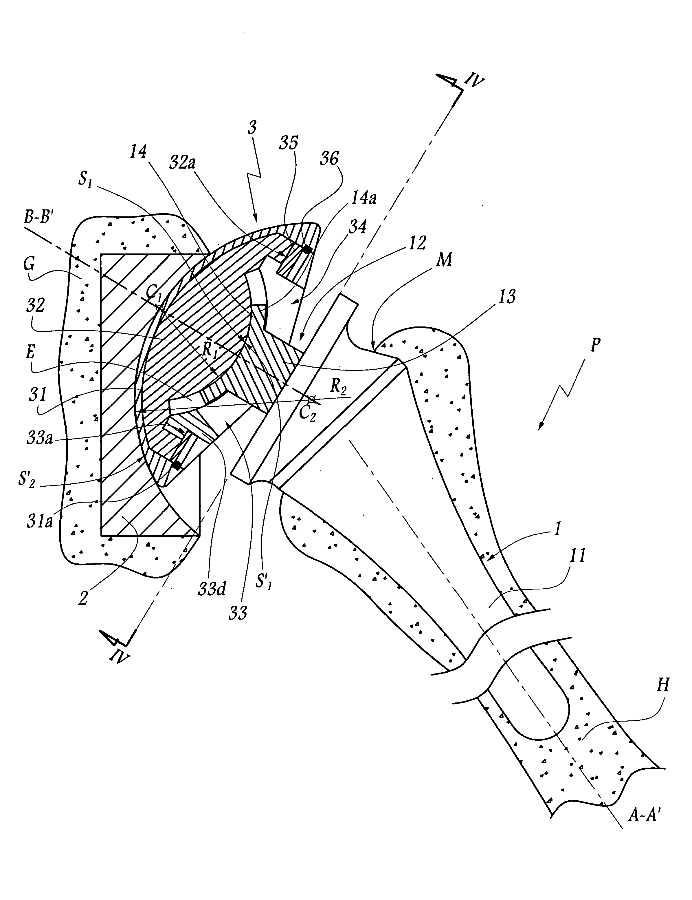 Shoulder or hip prosthesis and process for fitting same