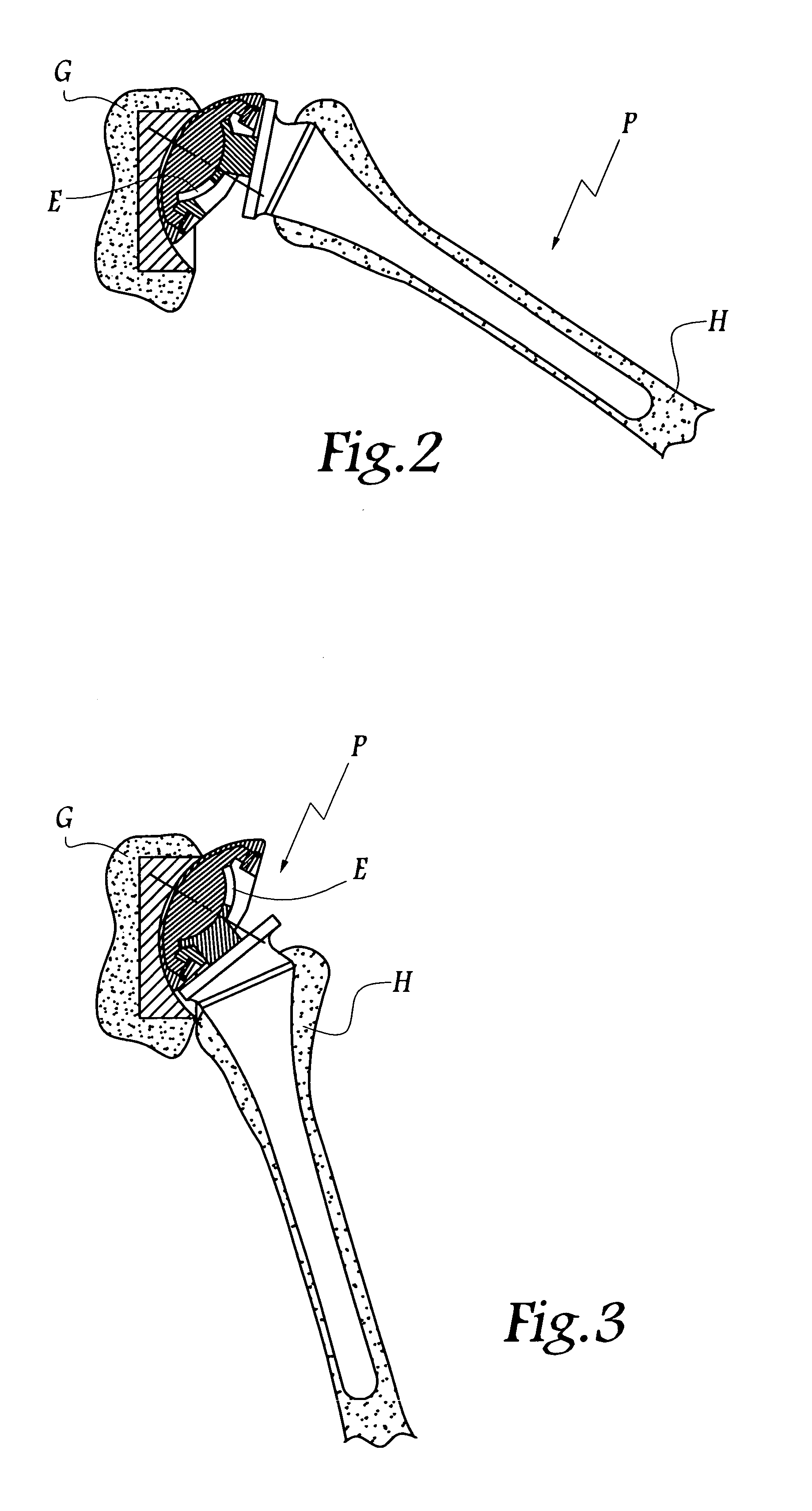 Shoulder or hip prosthesis and process for fitting same