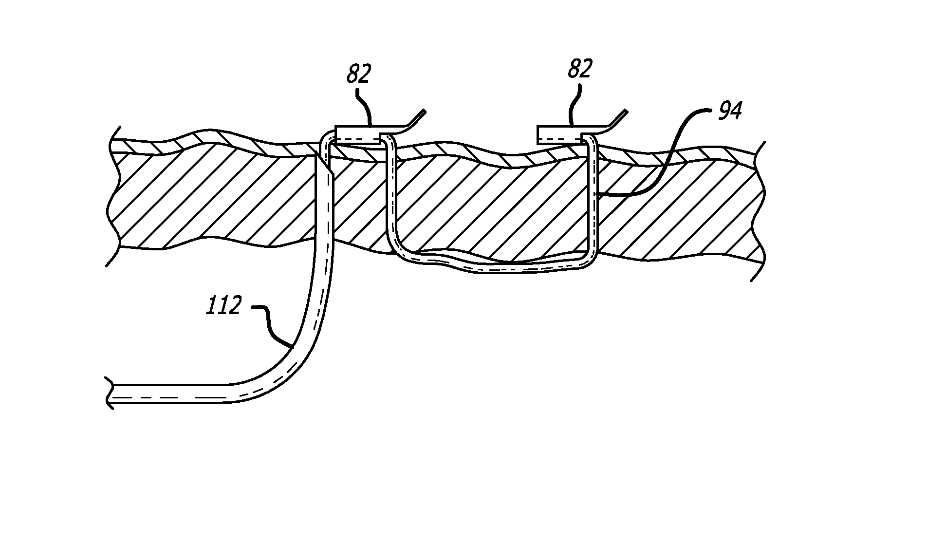 Apparatus and method for manipulating or retracting tissue and anatomical structure