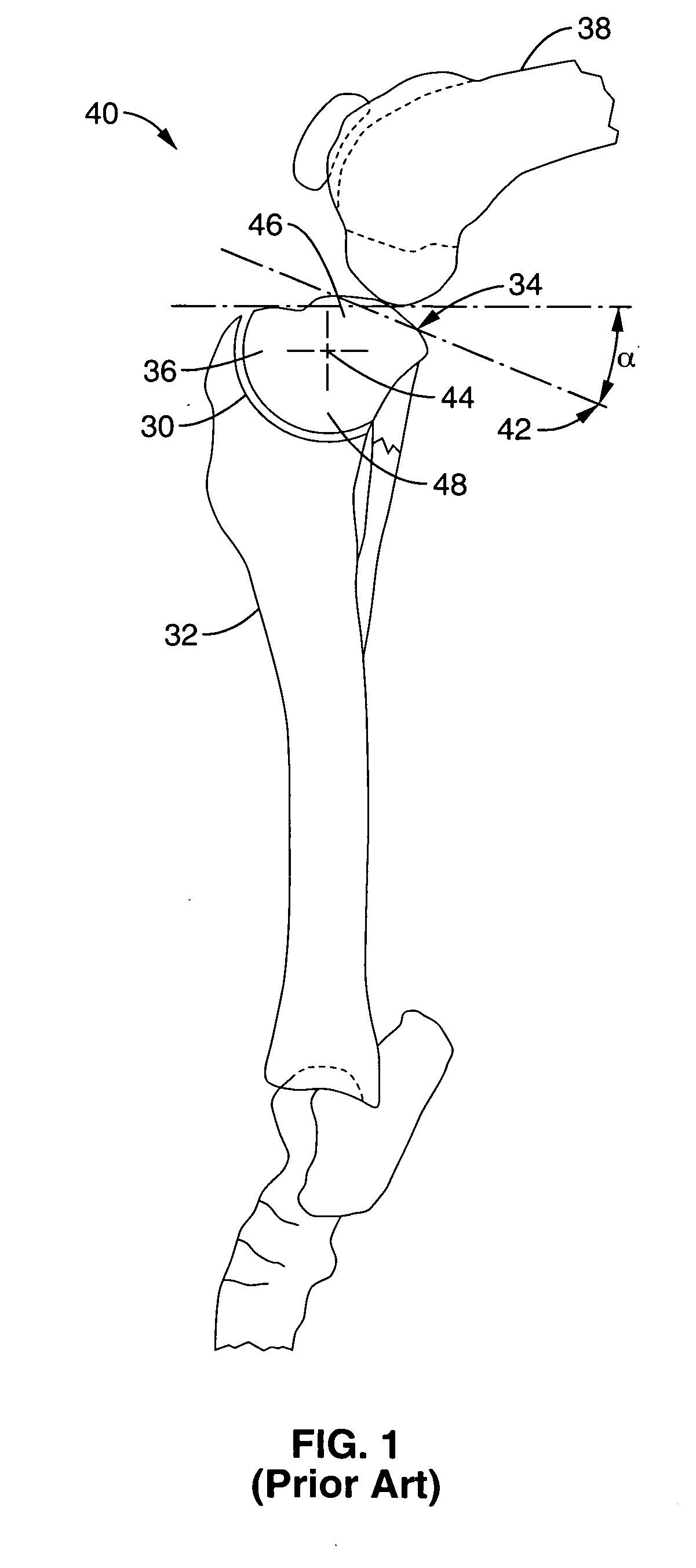 Apparatus and methods for tibial plateau leveling osteotomy