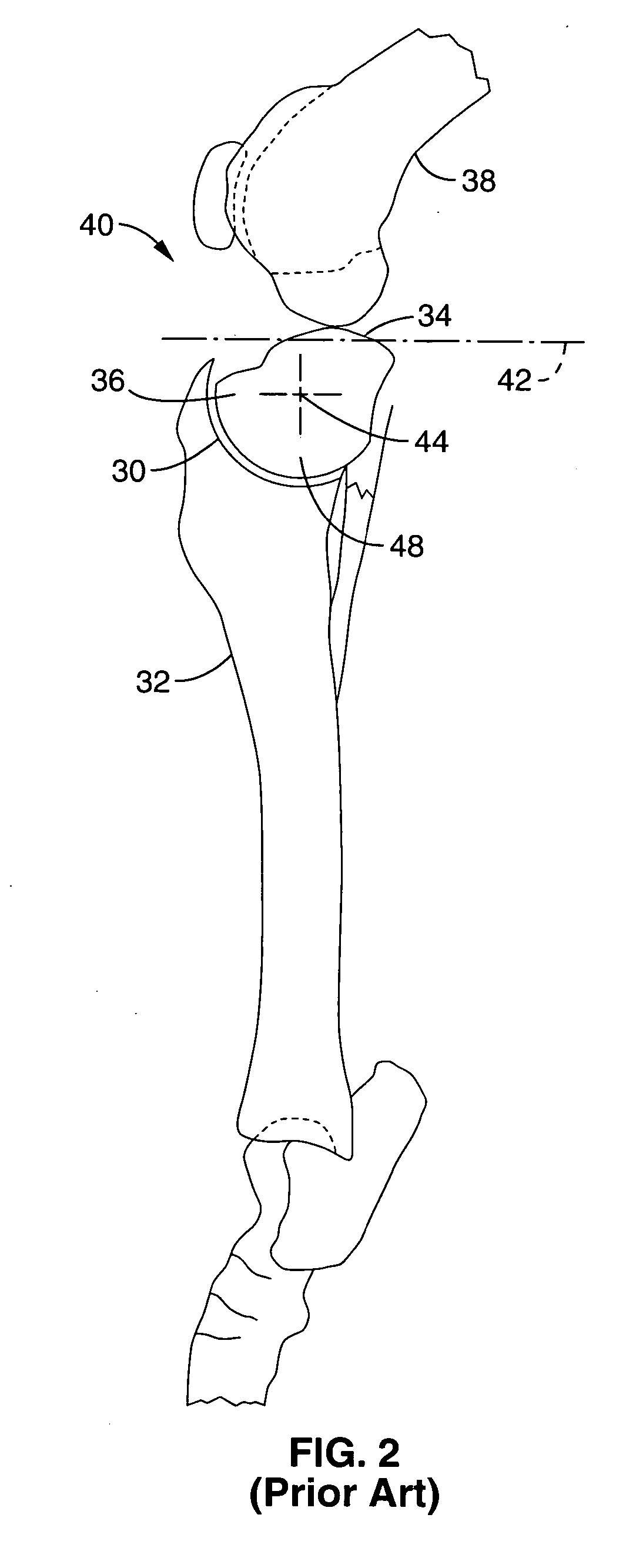 Apparatus and methods for tibial plateau leveling osteotomy