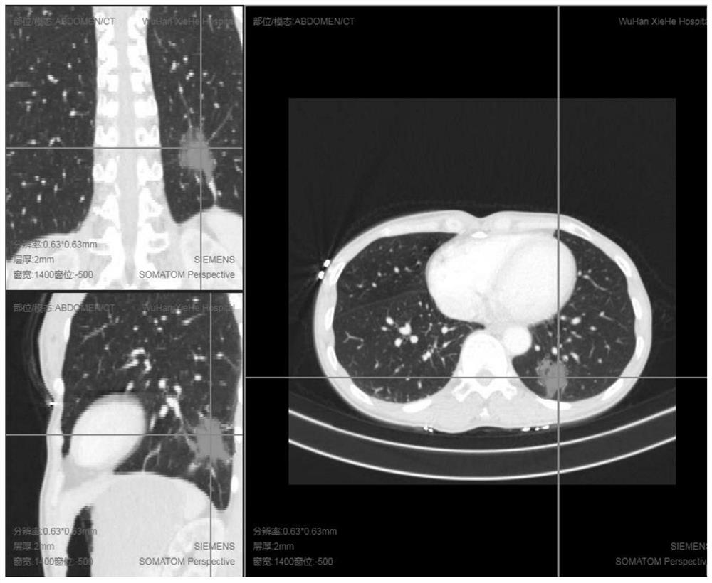 Pulmonary nodule interactive segmentation method based on medical image