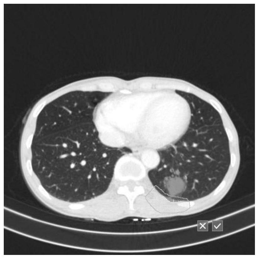 Pulmonary nodule interactive segmentation method based on medical image