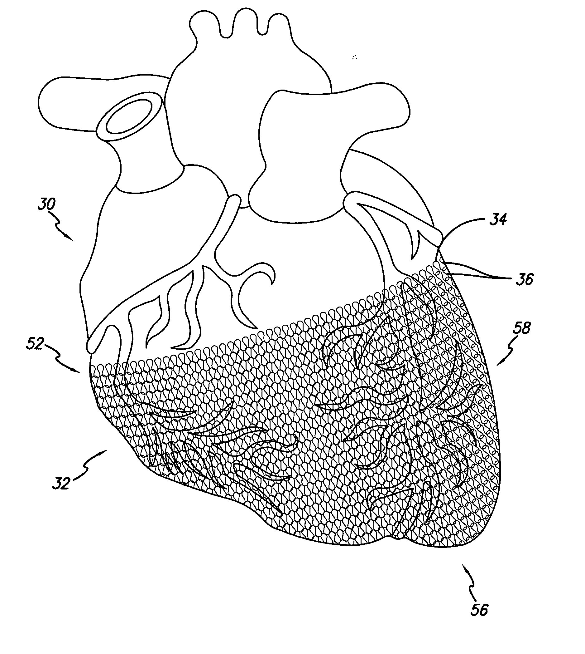 Apparatus and method of delivering biomaterial to the heart