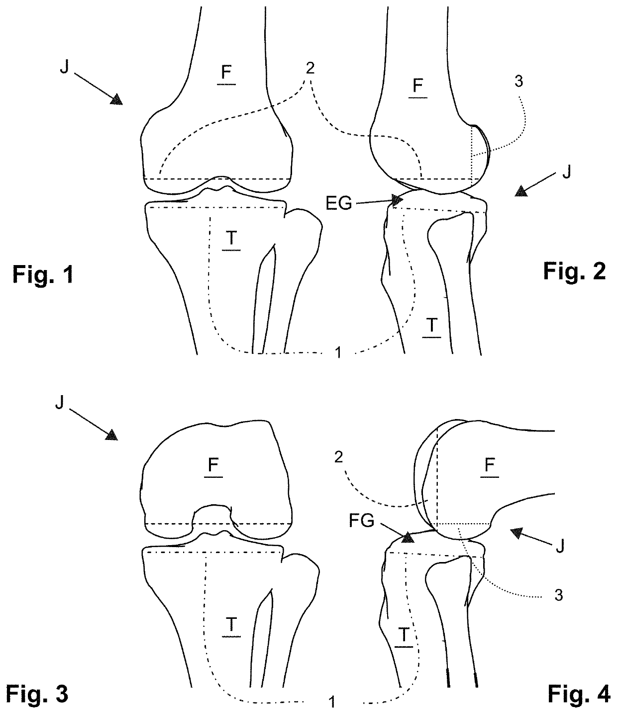 Apparatus and method for evaluating knee geometry